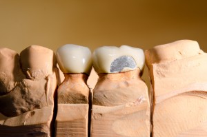 cracked teeth treatment in white rock