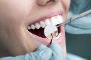 dental exam and cleaning white rock